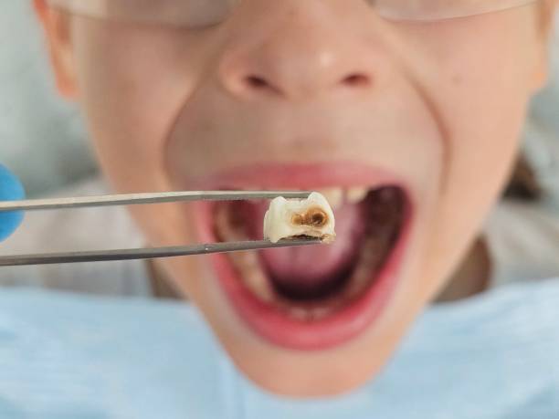 Best Broken or Chipped Tooth Repair in River Forest, IL